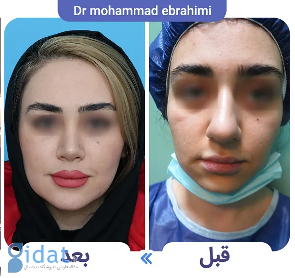 عمل جراحی بینی سربالا + ترمیم بینی خوکی